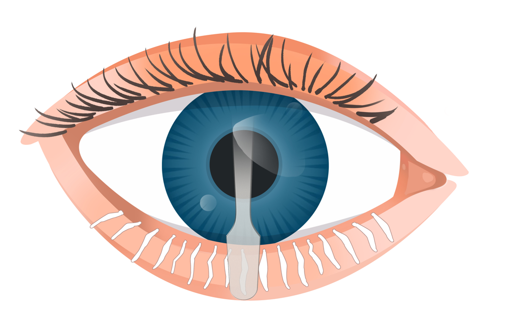 Meibomian Gland Expressor - Large