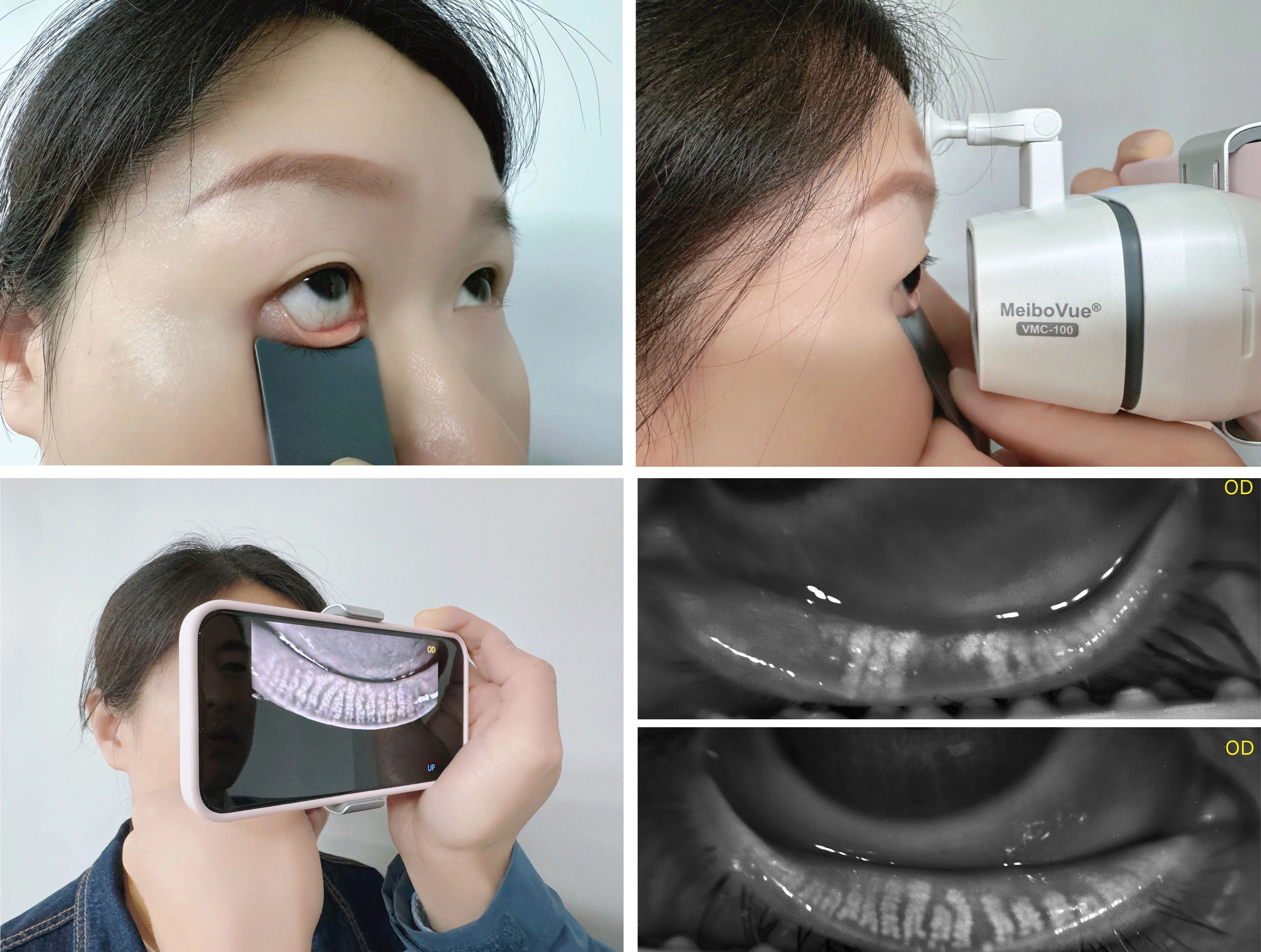 MeiboVue-Smartphone Meibographer