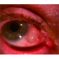 AnterVue Eye Imaging Camera
