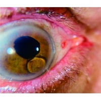 AnterVue Eye Imaging Camera
