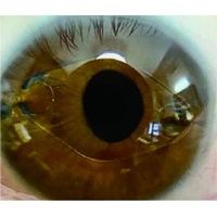 AnterVue Eye Imaging Camera